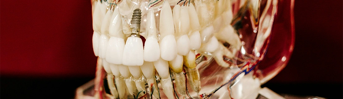 Dental Implants in Sheboygan WI – FC Dental Implants in Sheboygan WI – FC